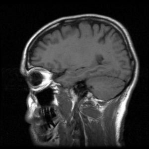 Latest cancer news xray scan of brain